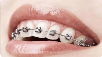 楔状缺损补牙 排龈线在颈部楔状缺损中的使用