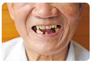 老年人牙齿的几种易发病症_健齿网